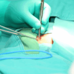Hernia mesh showing potential injury risks