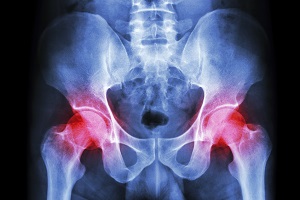 Deadline Extended for Patients Suffering from Complications Related to DePuy ASR Hip Replacement Recall