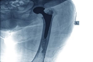 Hip Replacement Manufacturer Agrees To Pay Over $1 Billion in Major Settlement
