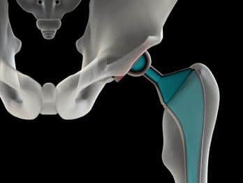 Stryker® Orthopaedics Rejuvenate Hip Implant Recall – Risk of Severe Side Effects and Additional Surgery