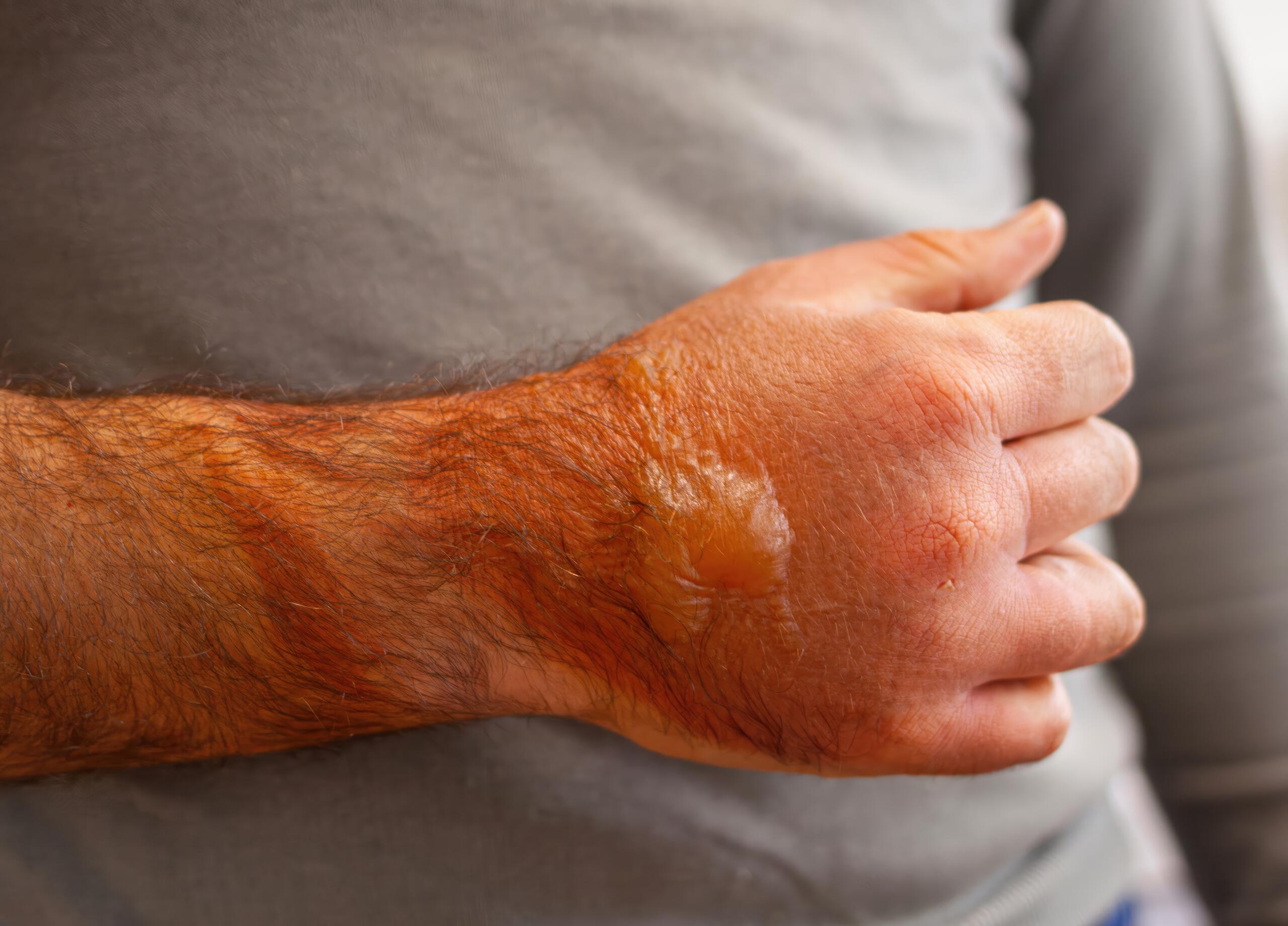 A close-up view of a person's hand and wrist featuring severe skin discoloration, swelling, and blisters from a recent thermal injury, illustrating cases handled by Tulsa burn injury attorneys.