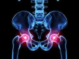 FDA: Updated Urgent Medical Device Recall DePuy Hip Implant – Class 1 Recall