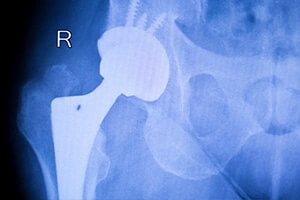 Hip Implant Recalls and How They Work