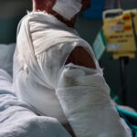 A patient sits in a hospital bed with extensive white medical bandages covering their shoulder, chest, and upper arm next to medical monitoring equipment, illustrating the long-term treatment required for burn injuries from car accidents in Oklahoma.
