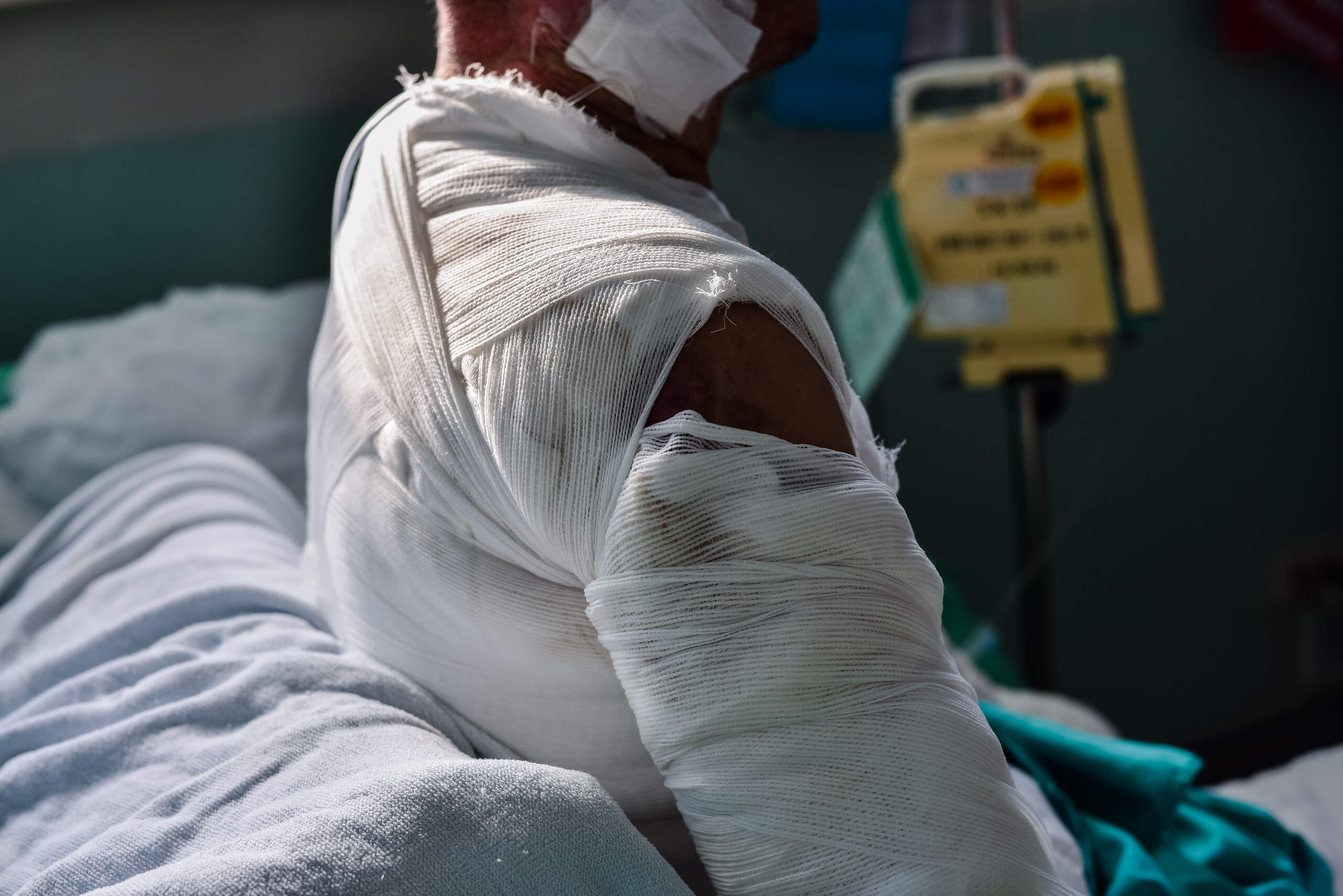 Burn Injuries From Car Accidents in Oklahoma: Legal Rights and Compensation