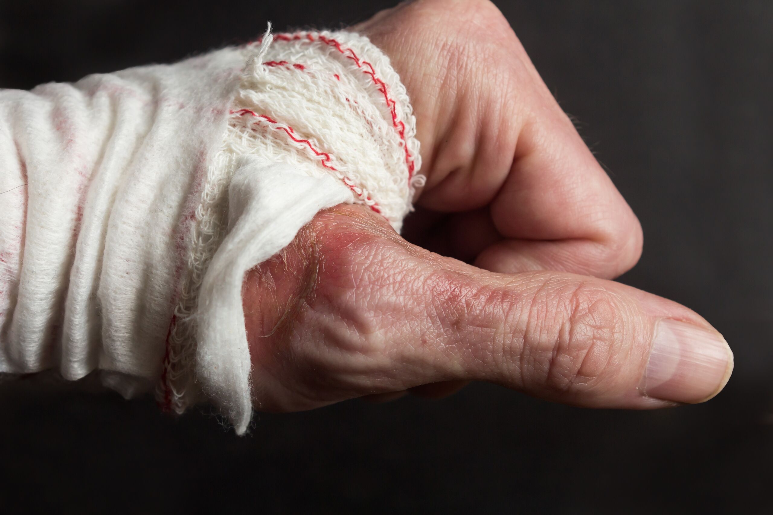 A close-up view of a person's hand showing red, irritated skin and blisters from a burn injury near the thumb, with white medical gauze wrapped around the wrist, reflecting severe burn injuries from car accidents in Oklahoma.