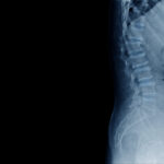 A side-view medical X-ray of a human lumbar spine and pelvic region against a solid black background, illustrating diagnostic evidence used in paraplegia vs. quadriplegia in Oklahoma injury claims.