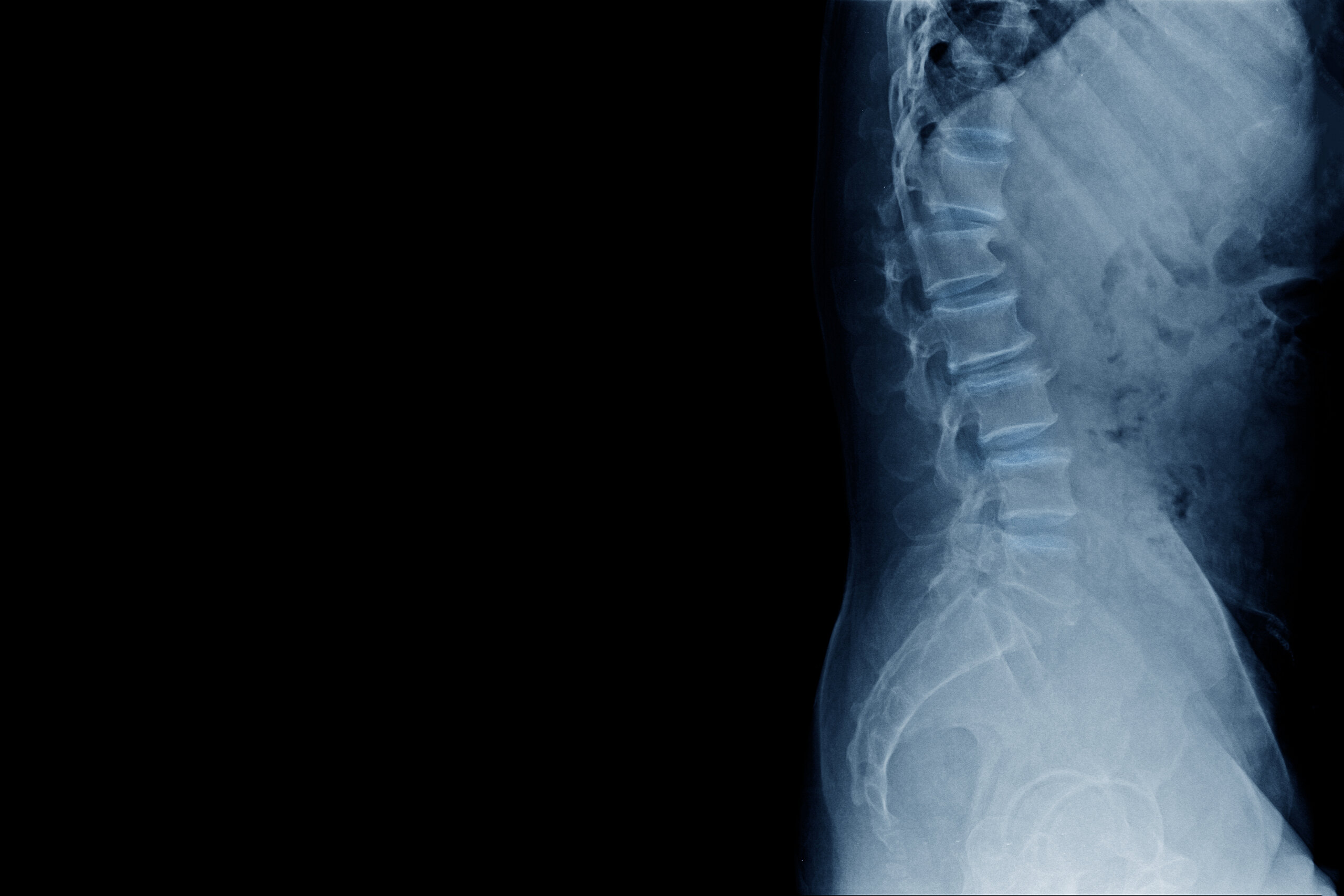 Paraplegia vs. Quadriplegia in Oklahoma Injury Claims: How Injury Type Affects Your Compensation